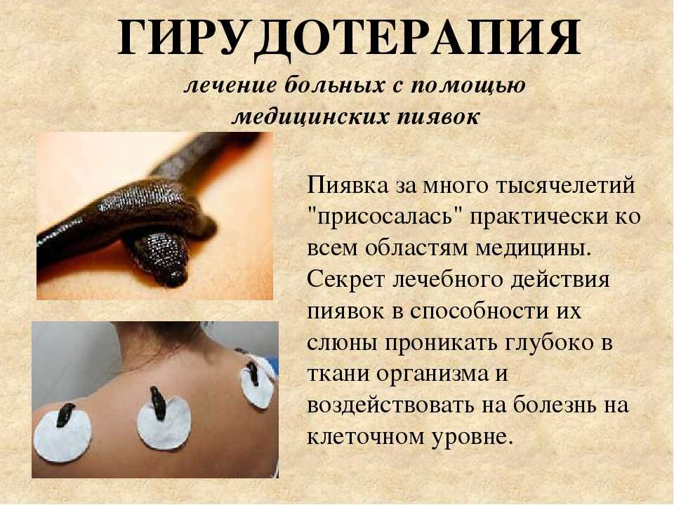 Как правильно ставить пиявки в домашних условиях схема и видео пошагово